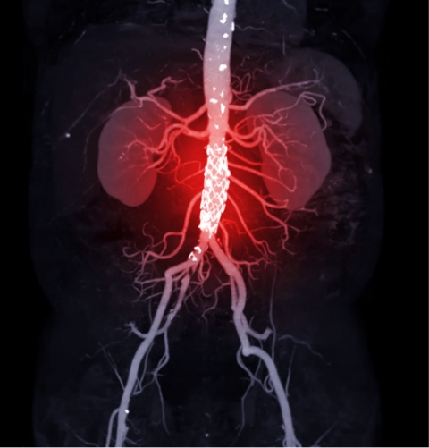 Abdominal aortic aneurysm 
