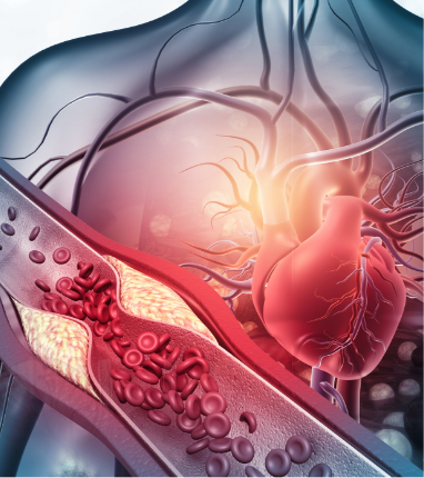 Angiogram