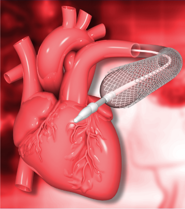 Angioplasty