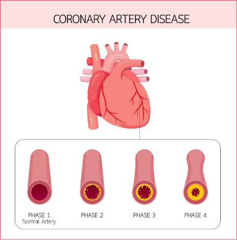 Coronary Artery Disease