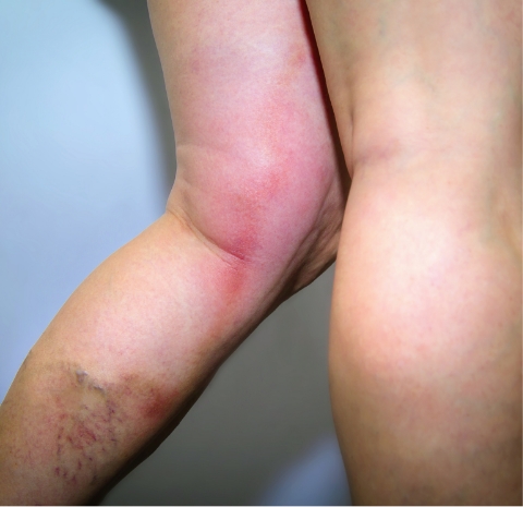 Deep vein thrombosis