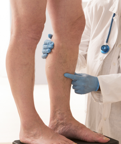 Deep Vein Thrombosis