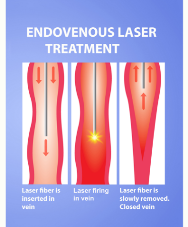 Endovenous Laser
