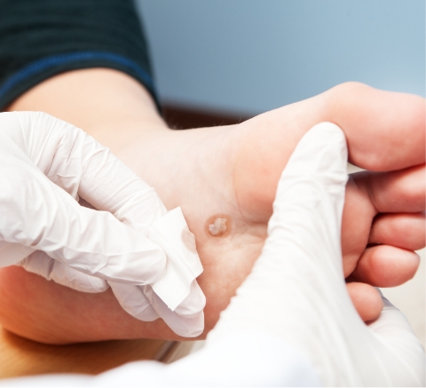 Foot ulcer