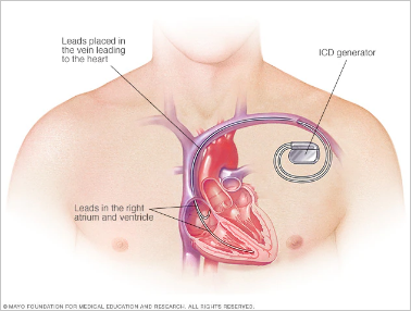 Implantable cardioverter-defibrillator (ICD)
