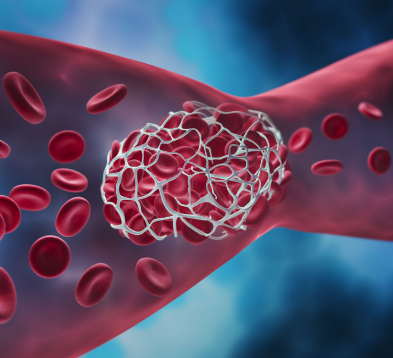Central Venous Stenting