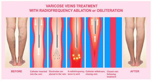 Radiofrequency Ablation