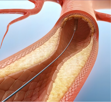 Stent Insertion