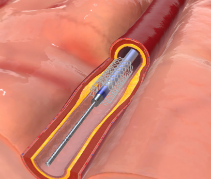 Stenting