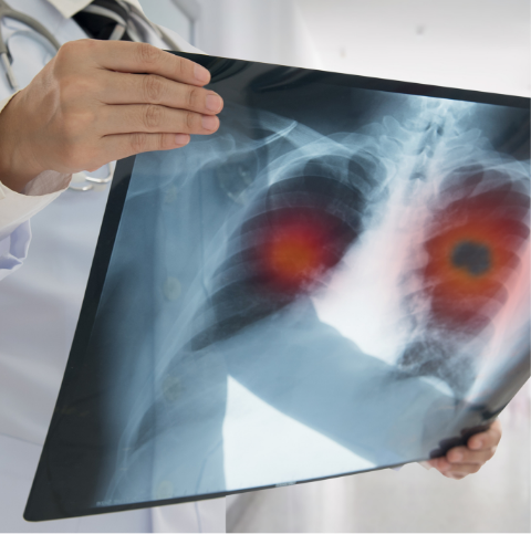 Thoracic & Mediastinal Tumours