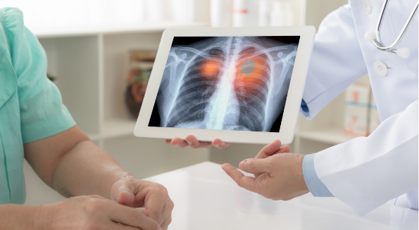 Thoracic & Mediastinal Tumours
