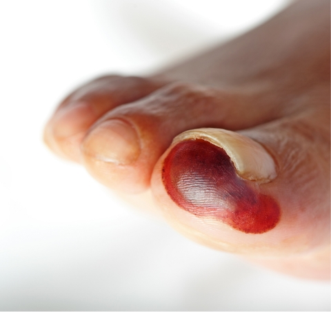 Toe gangrene