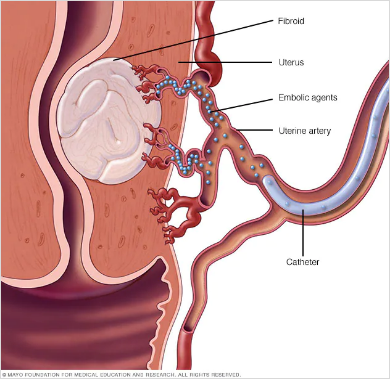 Understanding Embolization Procedures