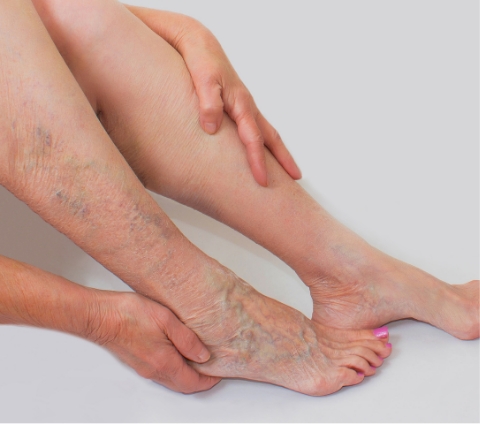 Varicose veins
